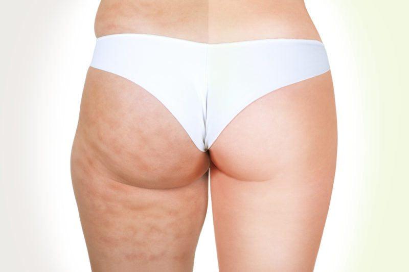 4 Tips to Reduce Cellulite that Take Little Time and Effort