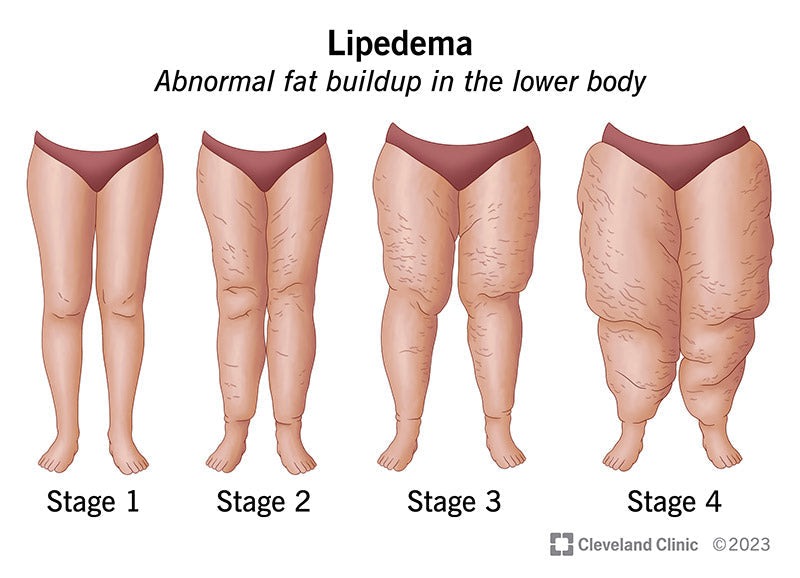 Understanding Lipedema