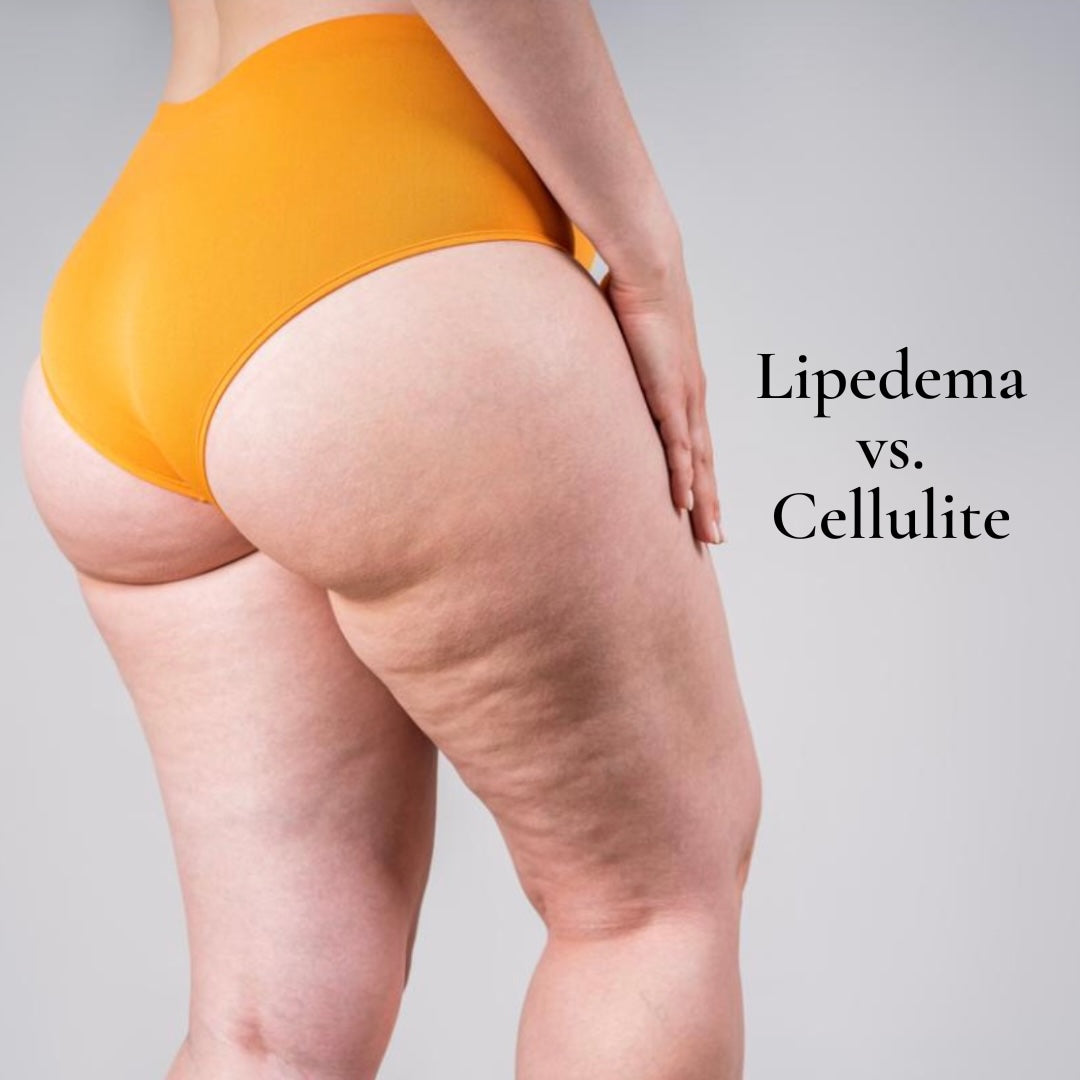 Lipedema vs. Cellulite
