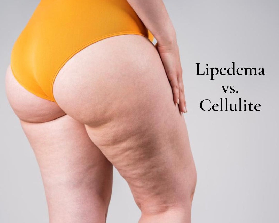 Lipedema vs. Cellulite