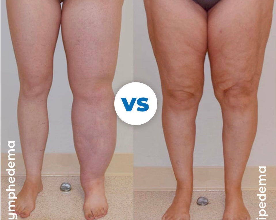 Lipedema vs Lymphedema