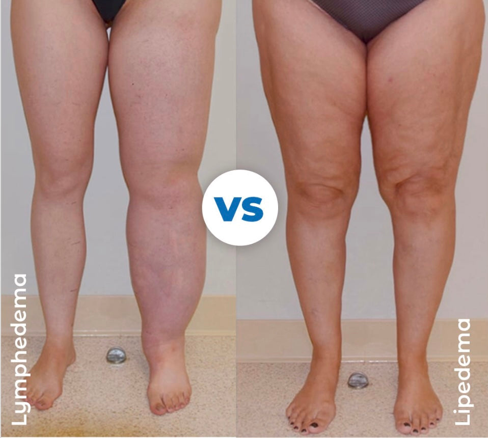 Lipedema vs Lymphedema
