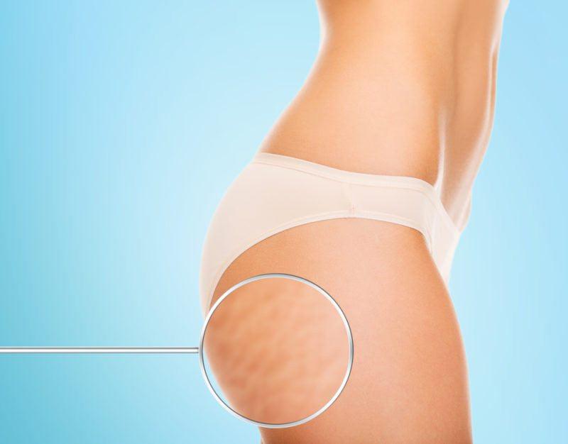 Why Cellulite Isn’t the Enemy - TheBlackPurple