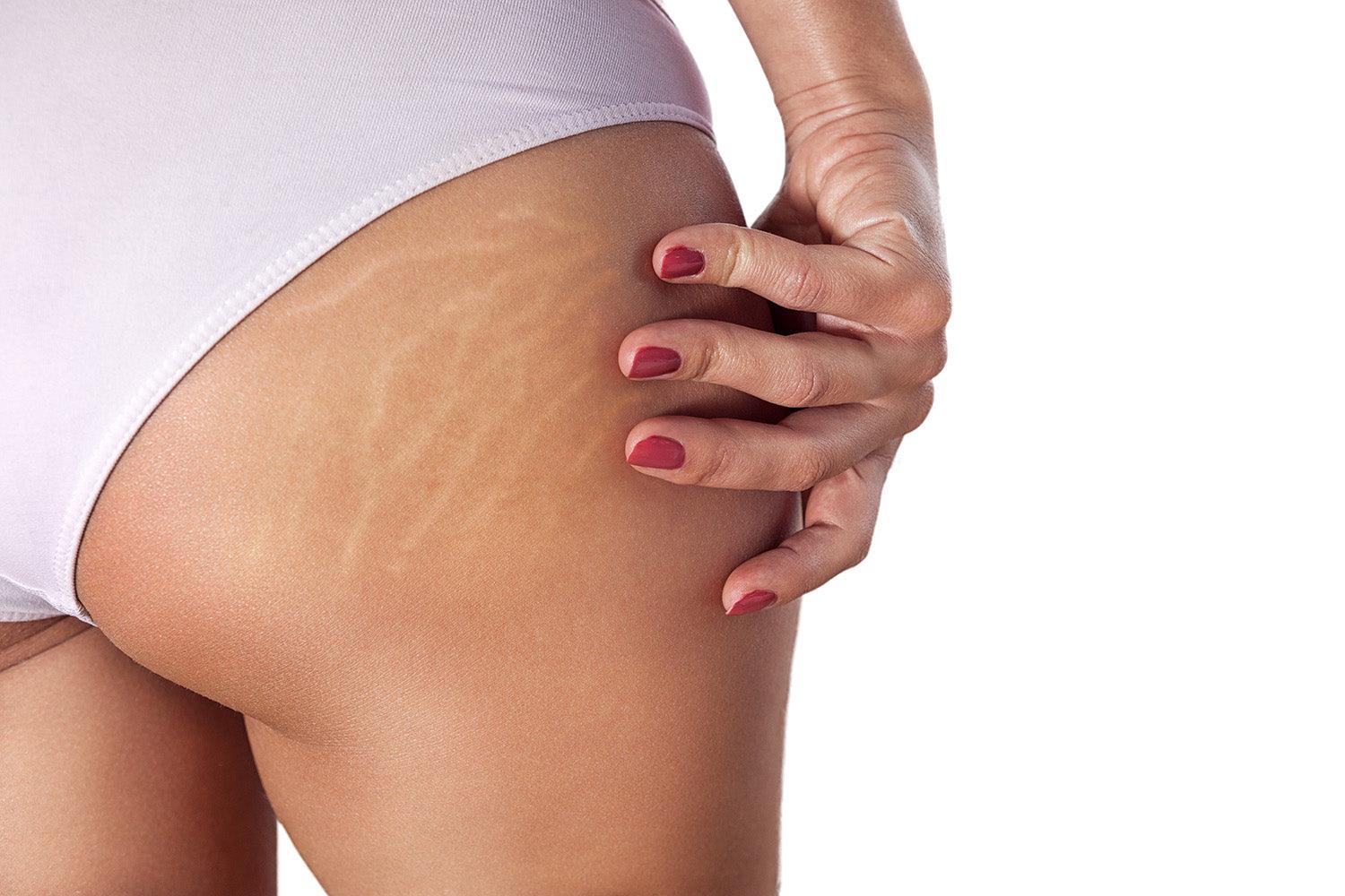 Here are 5 cellulite facts & myths in today's article by The Black Purple