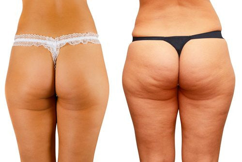 Cellulite After 45: Causes, Myths & How to Reduce It for Smoother Skin