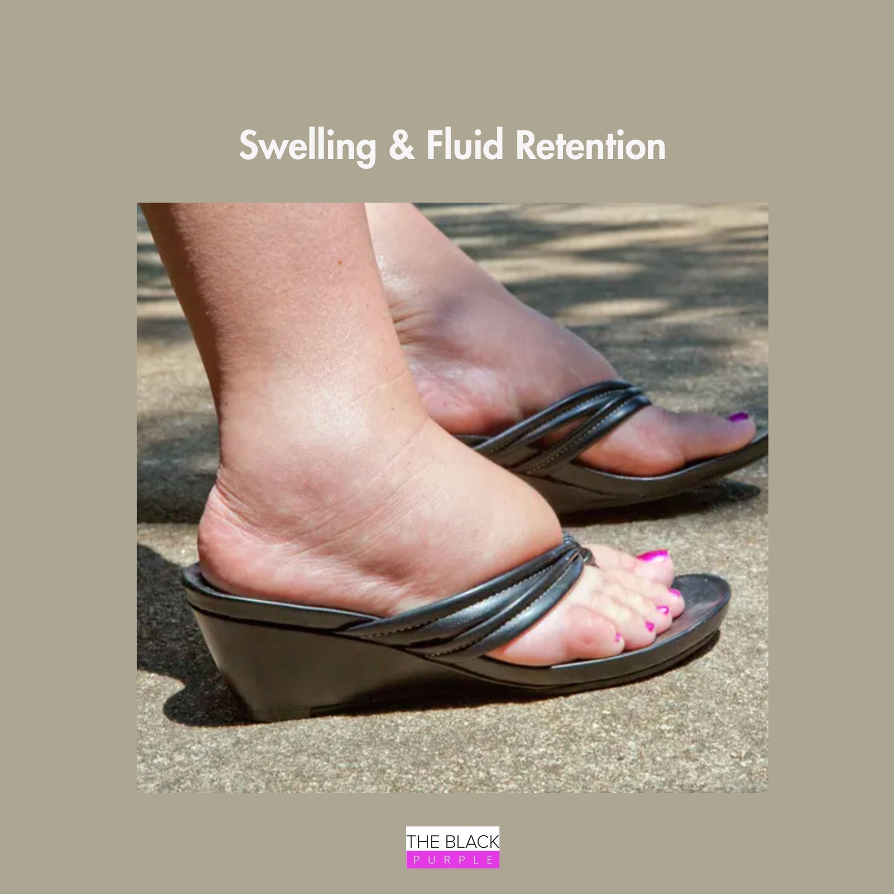 Swollen feet and ankles illustrating postpartum swelling and fluid retention commonly experienced after pregnancy.