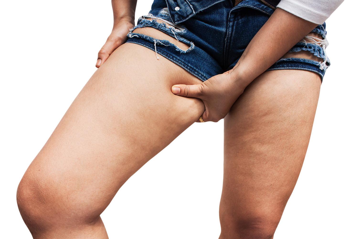 How to prevent thigh chafing