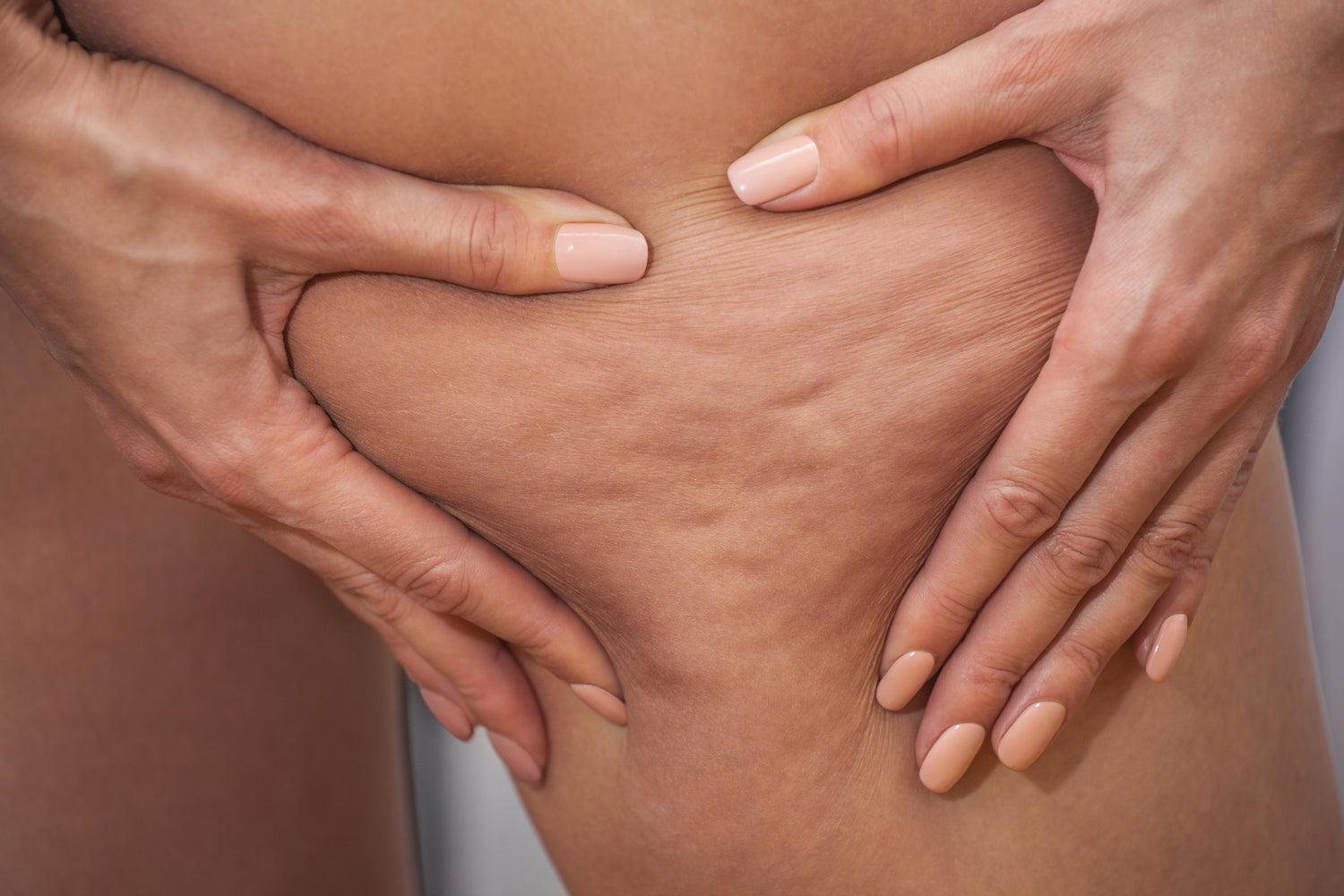 Surprising causes of cellulite